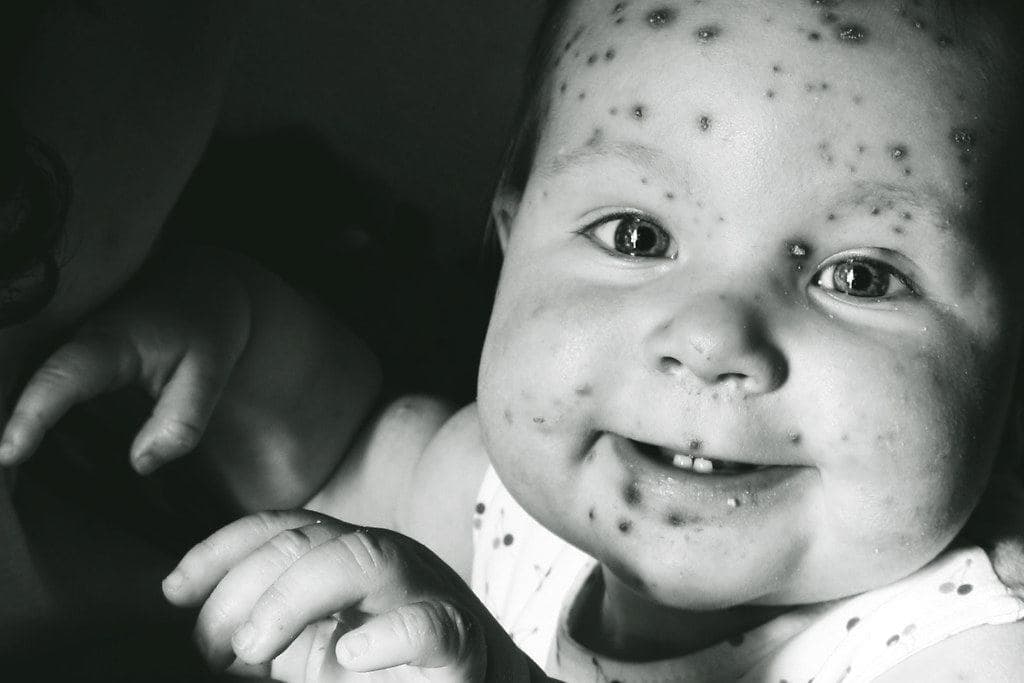 Chickenpox: Symptoms, How Long It Is Contagious and the New UK Vaccine
