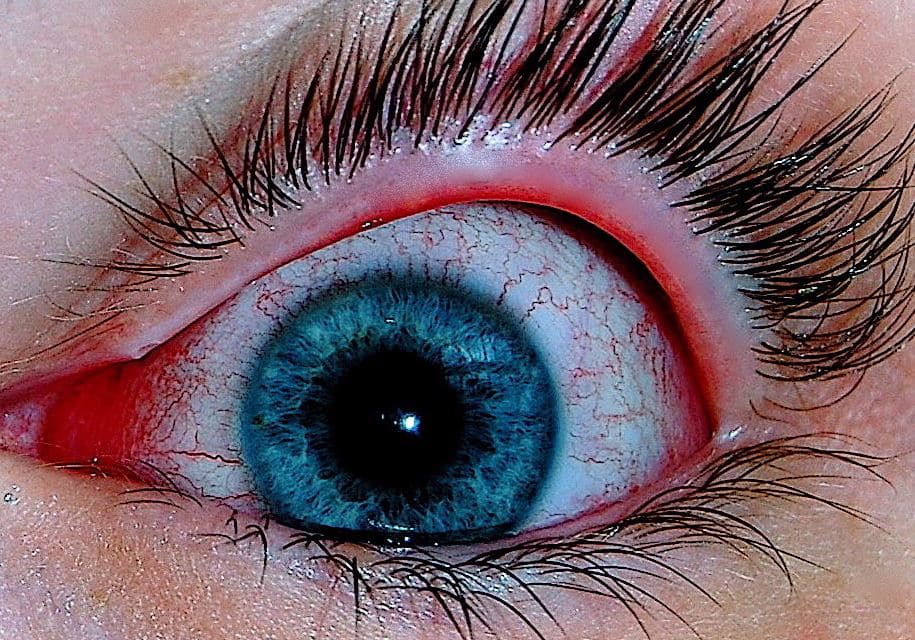 COVID-19 Eye Symptoms: Conjunctivitis and Pink Eye Explained