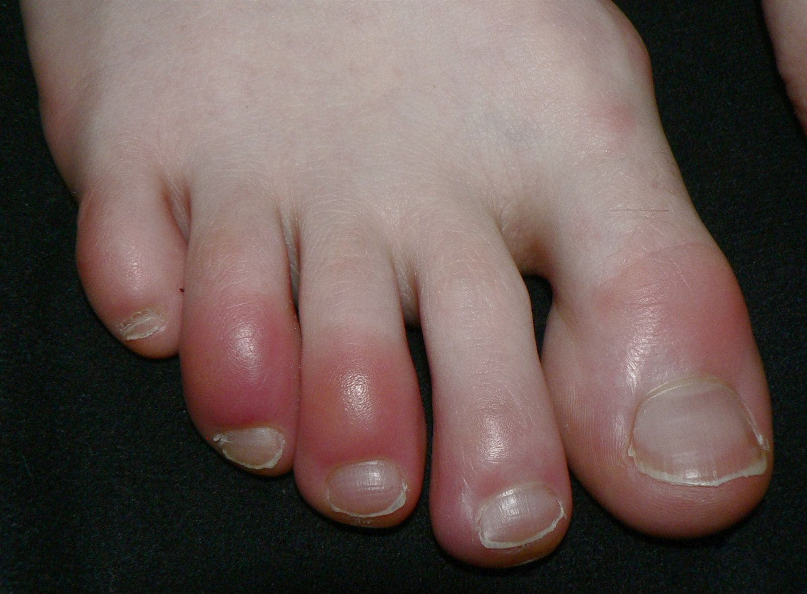 COVID-19 Rash and Skin Symptoms: What's Behind 'COVID Toes'