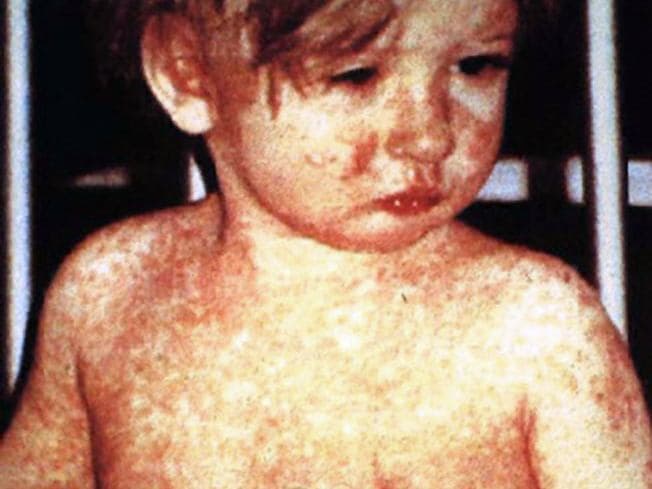 Measles Is Back in the UK: Symptoms, Risks and the MMR Vaccine