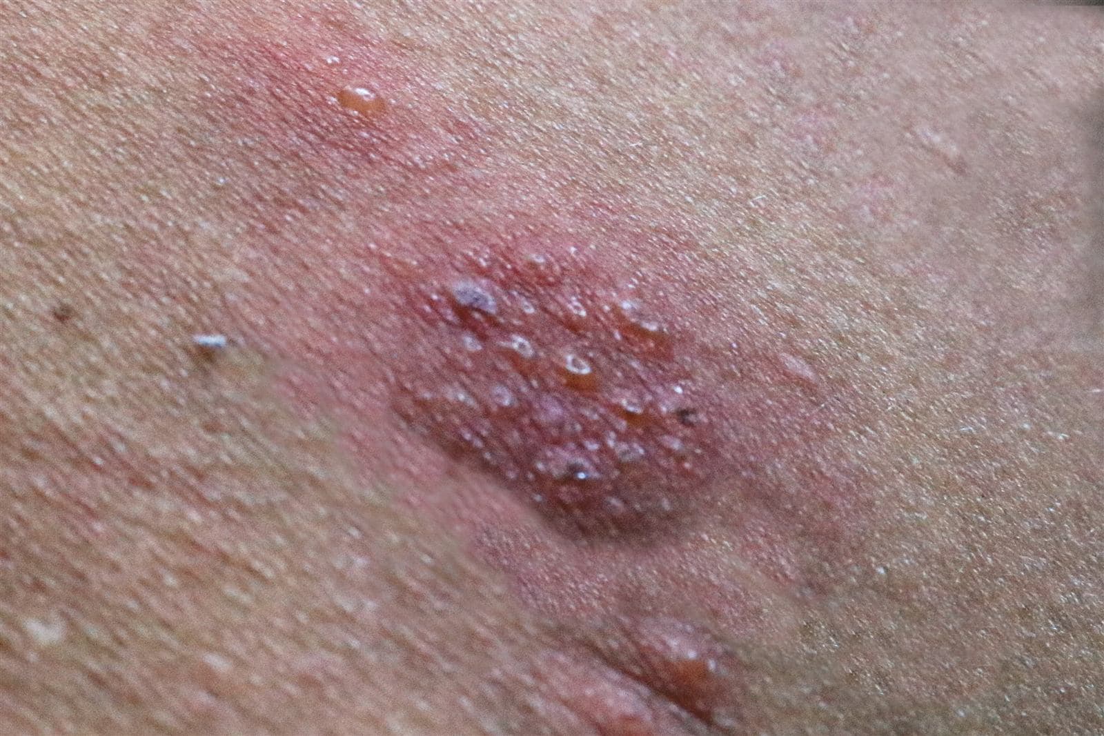 Shingles: Symptoms, Treatment and Who Gets the NHS Vaccine