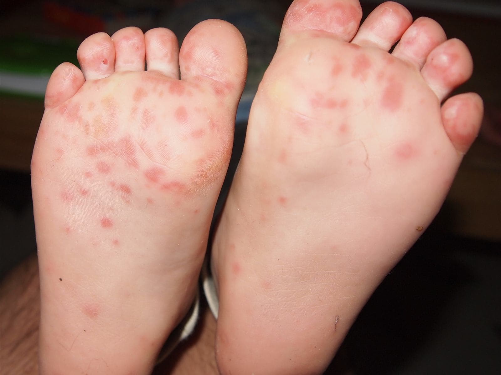 Hand, Foot and Mouth Disease: Symptoms, Nursery and How Long It Lasts