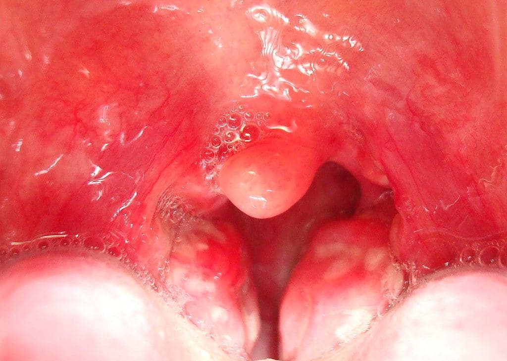 Tonsillitis: Symptoms, Treatment and When You Need Antibiotics